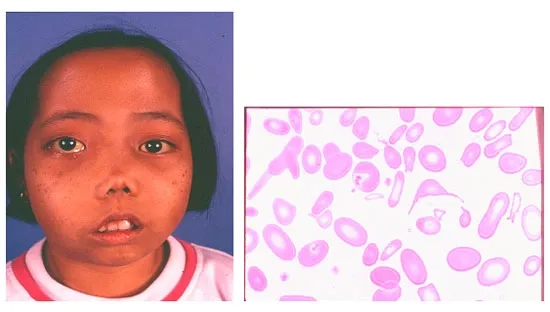 An infographic explaining the thalassemia trait