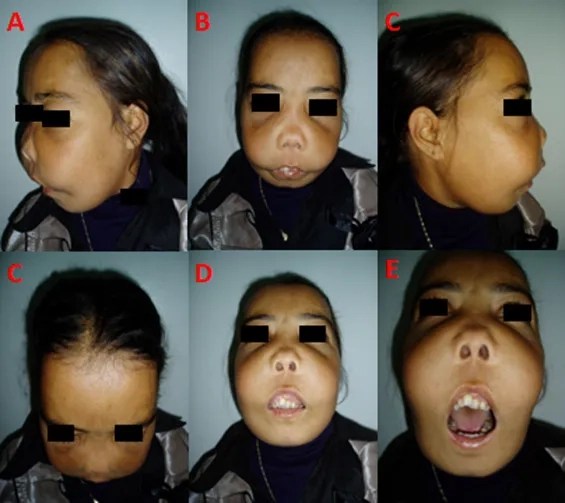 Understanding the genetics of thalassemia minor