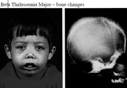 The effects of thalassemia major on red blood cells