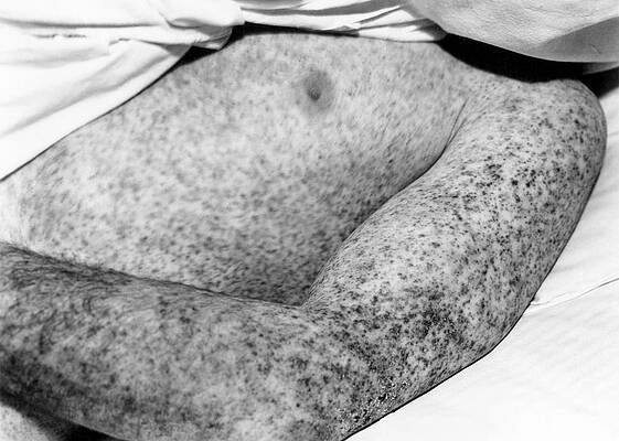 Information on is Colorado tick fever contagious