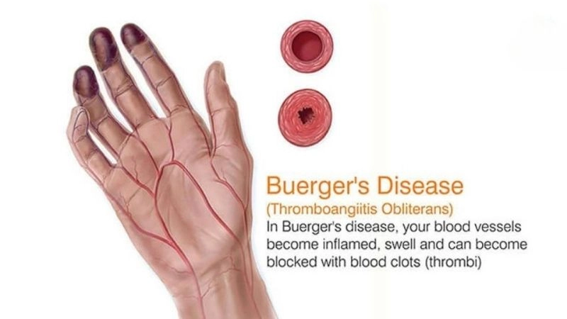 Thromboangiitis obliterans treatment options explained