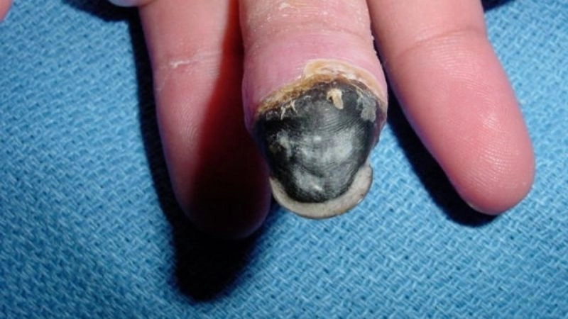 Critical limb ischemia as a severe health threat