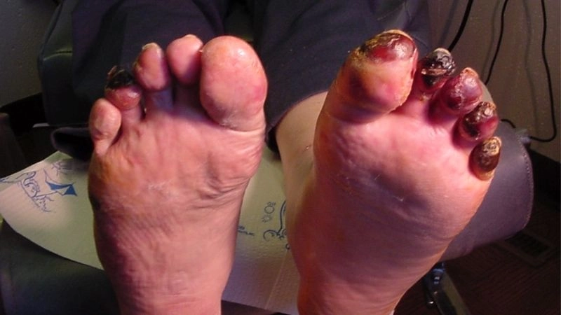 Buerger's disease vs atherosclerosis major differences