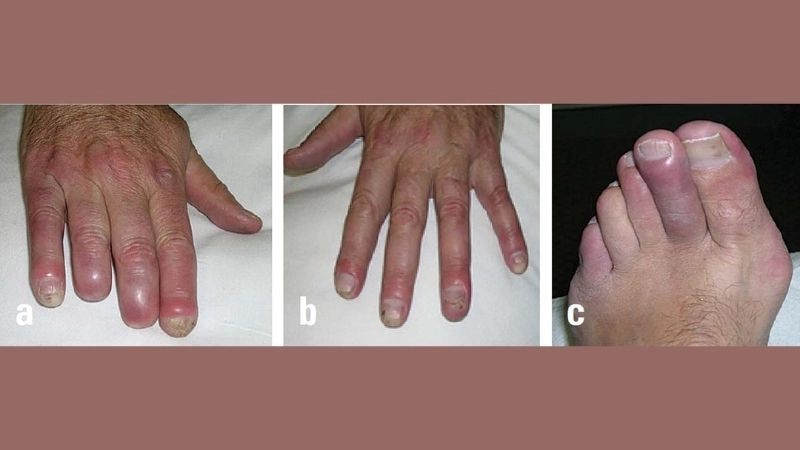 Thromboangiitis obliterans pathogenesis in detail