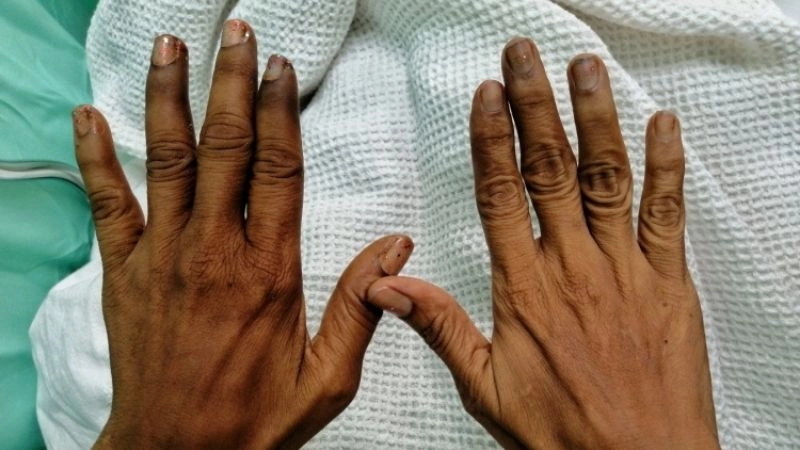 Buerger's disease amputation as a tragic outcome