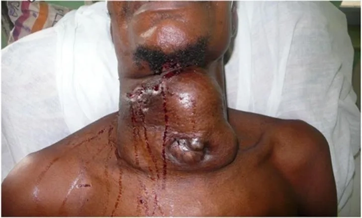 A surgeon performing a thyroidectomy