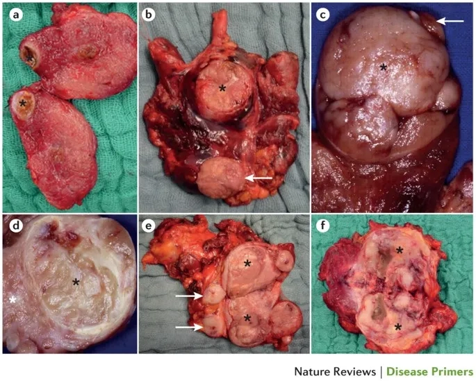 Ultrasound image of thyroid nodules on a gland