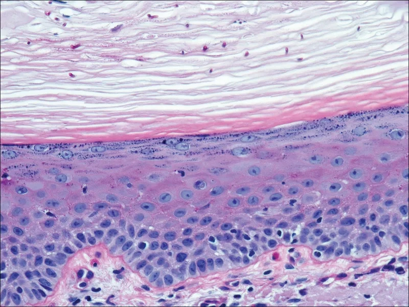 A close-up view of scalp ringworm on a child