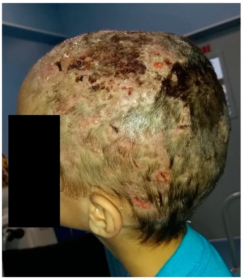 A severe inflammatory reaction known as a kerion