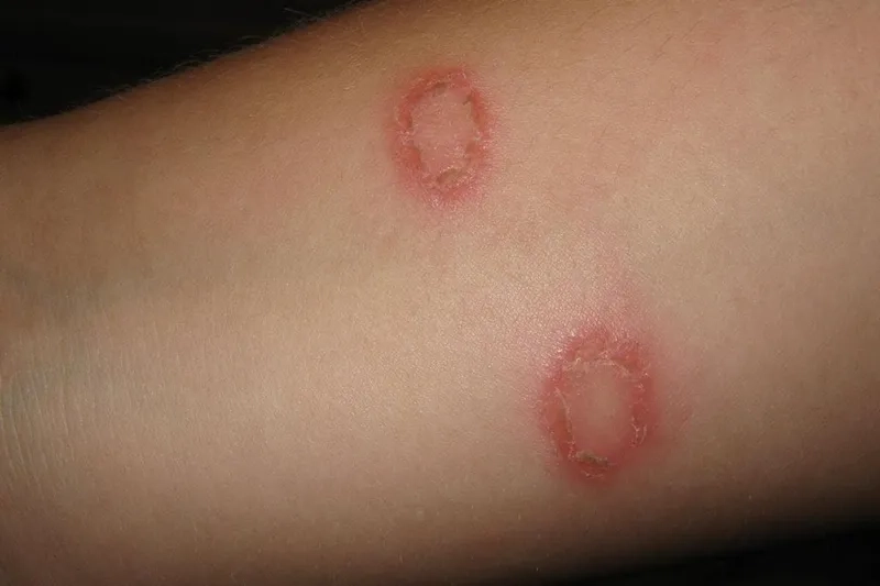Applying a Topical Ringworm Treatment Cream