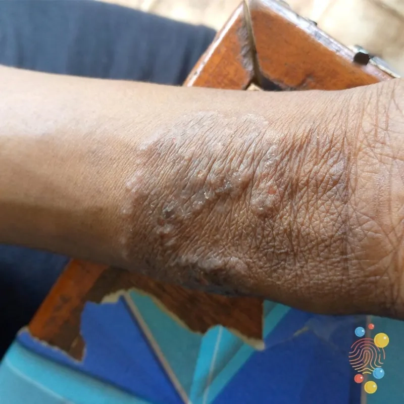 Is Body Ringworm Contagious: A Guide to Spread