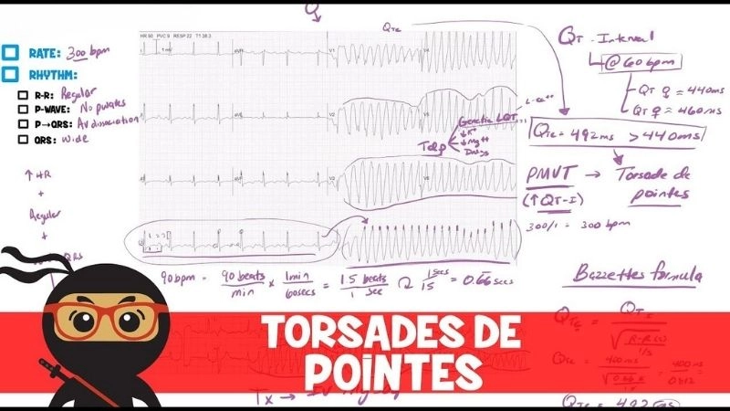 Torsades De Pointes Symptoms show sudden fainting spells