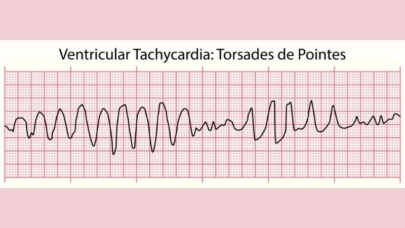 Torsades De Pointes Causes linked with prolonged QT