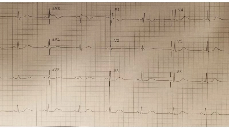 Drug Induced Torsades De Pointes triggered by medication