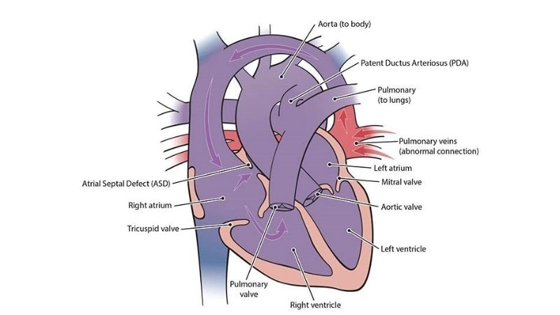 Total anomalous pulmonary venous return surgery and outcomes