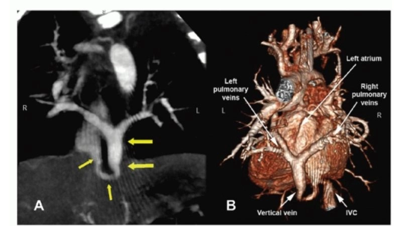 Cardiac total anomalous pulmonary venous return characteristics