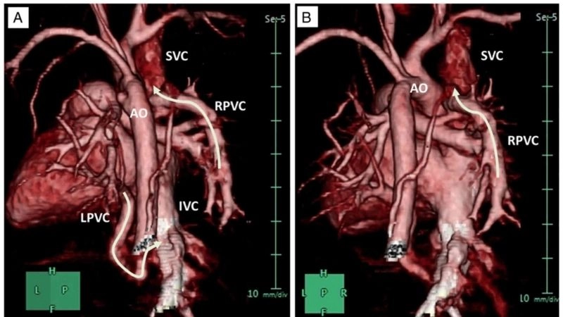 Total anomalous pulmonary venous return repair procedures