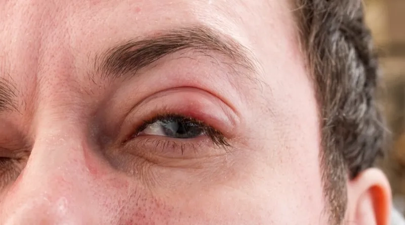 Trachoma: the world's leading cause of blindness