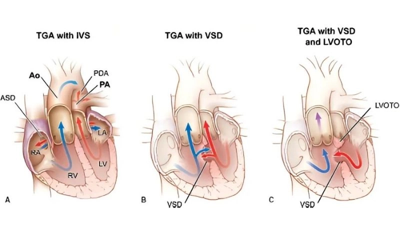 Transposition of the great arteries causes heart development issues