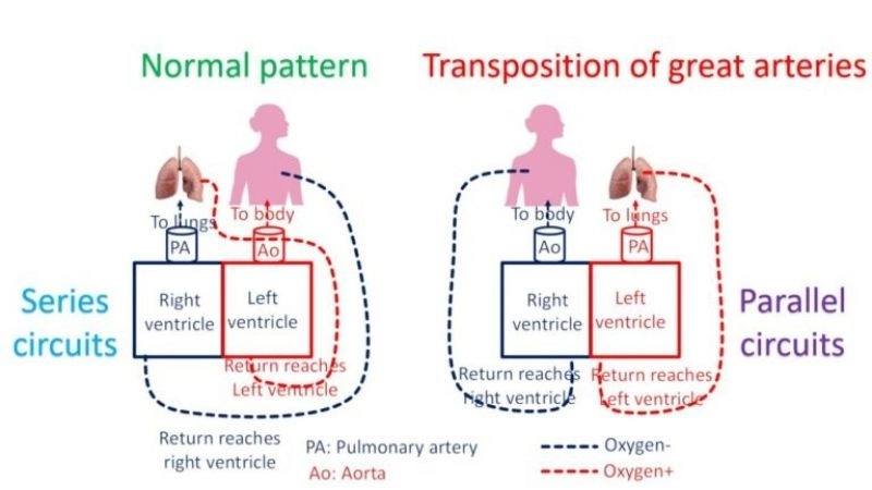 Transposition of the great arteries surgery correcting blood flow