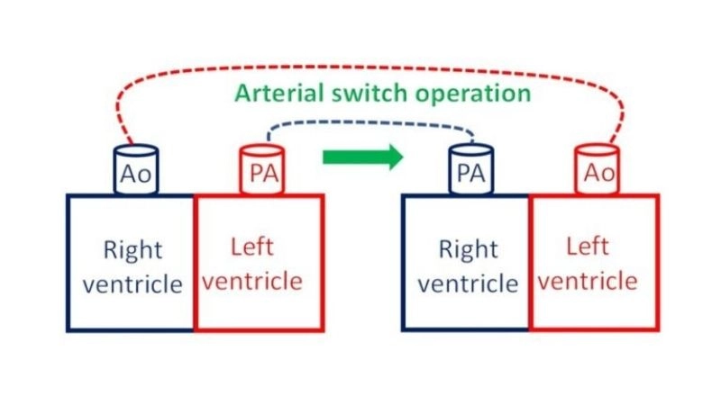 Dextro transposition of the great arteries serious congenital defect
