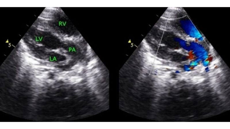 Transposition of the great arteries in adults rare late diagnosis