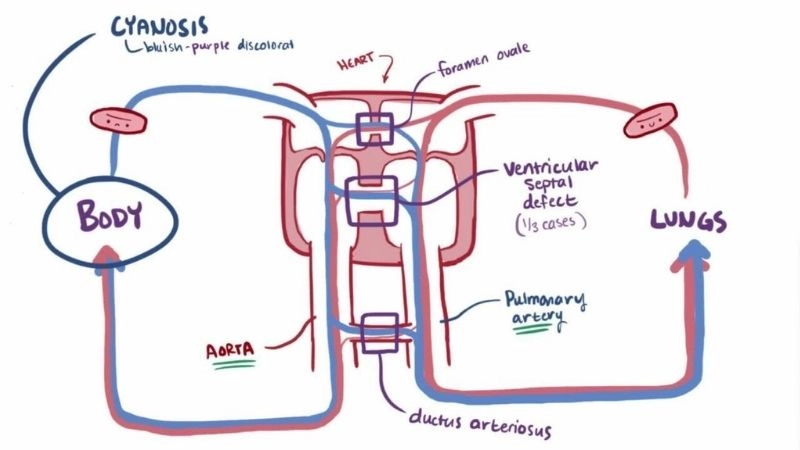 Transposition of the great arteries in infants common early finding