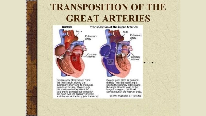 Transposition of the great arteries echo key tool for diagnosis