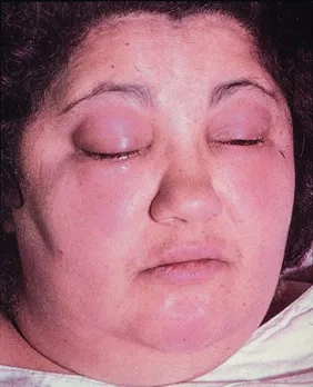 The clinical diagnosis of trichinosis