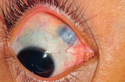 Trichinosis risk from undercooked pork