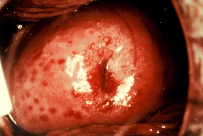 Clinical pictures of trichomoniasis discharge