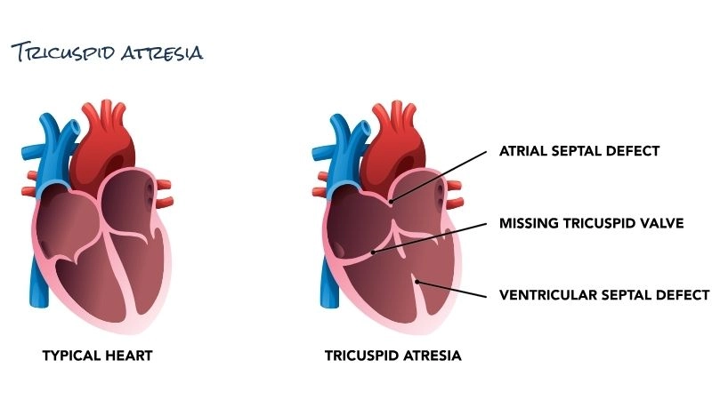Tricuspid atresia symptoms and warning signs explained