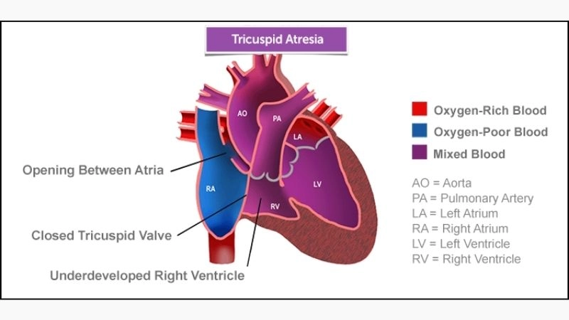 Tricuspid atresia surgery procedures and recovery