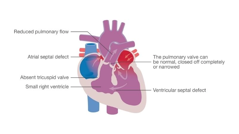 Tricuspid atresia life expectancy survival outlook