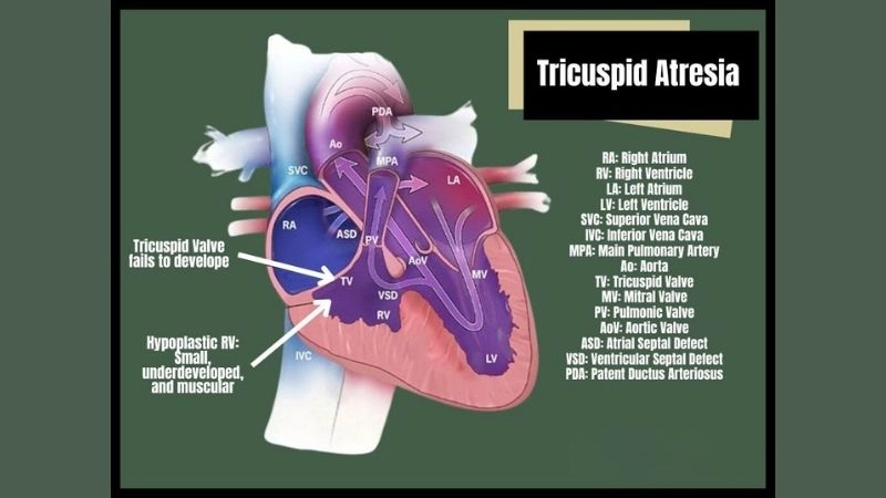 Tricuspid atresia prognosis long term management