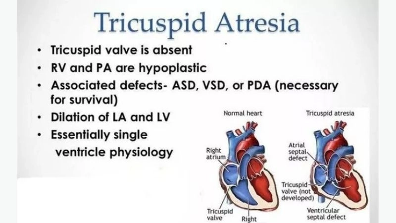 Tricuspid atresia in adults rare cases overview