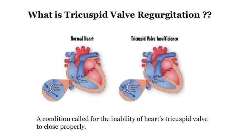 Tricuspid Regurgitation Symptoms include fatigue and swelling