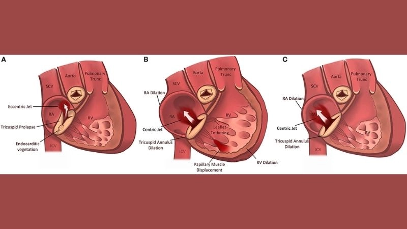 Tricuspid Regurgitation Diagnosis confirmed with echocardiogram
