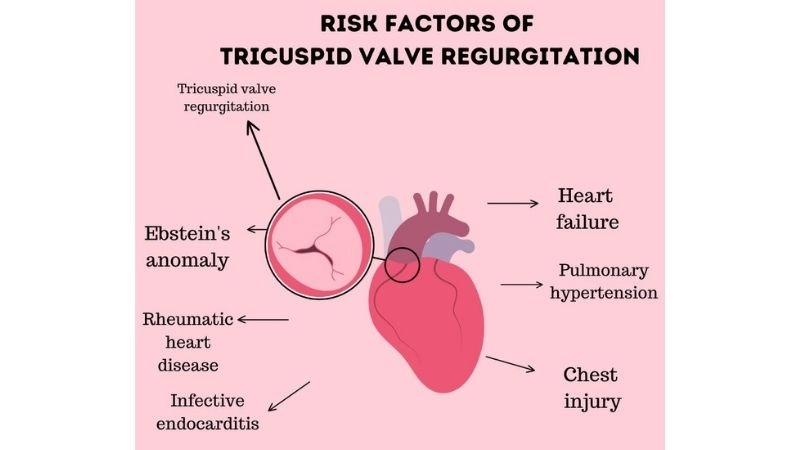 Tricuspid Regurgitation In Pregnancy requires careful monitoring