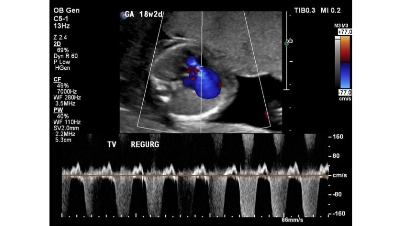 Tricuspid Regurgitation Life Expectancy depends on severity