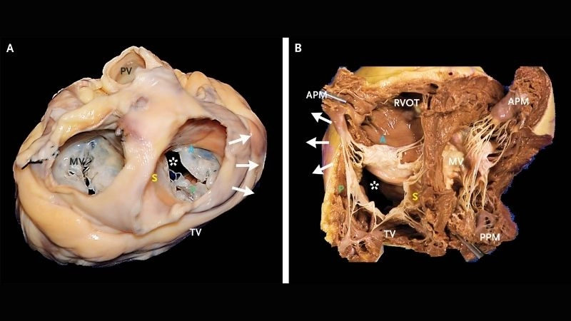 Tricuspid Regurgitation Echo helps measure severity
