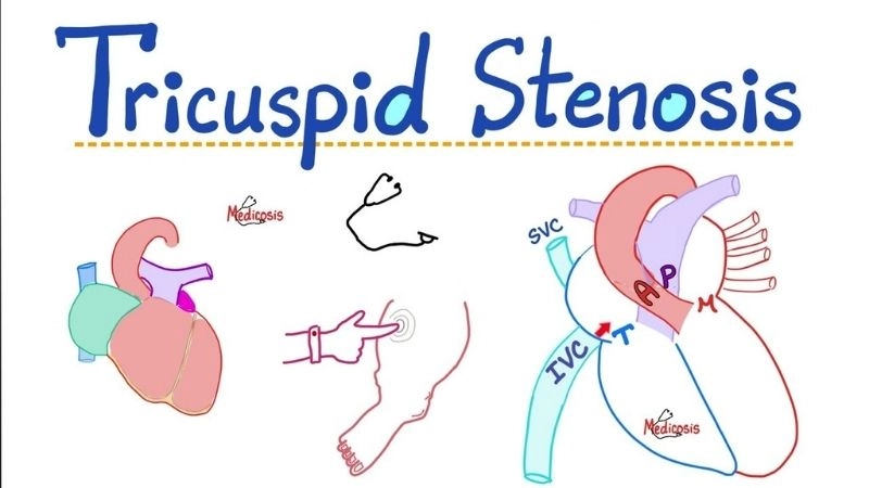 Tricuspid Stenosis Symptoms include fatigue and swelling