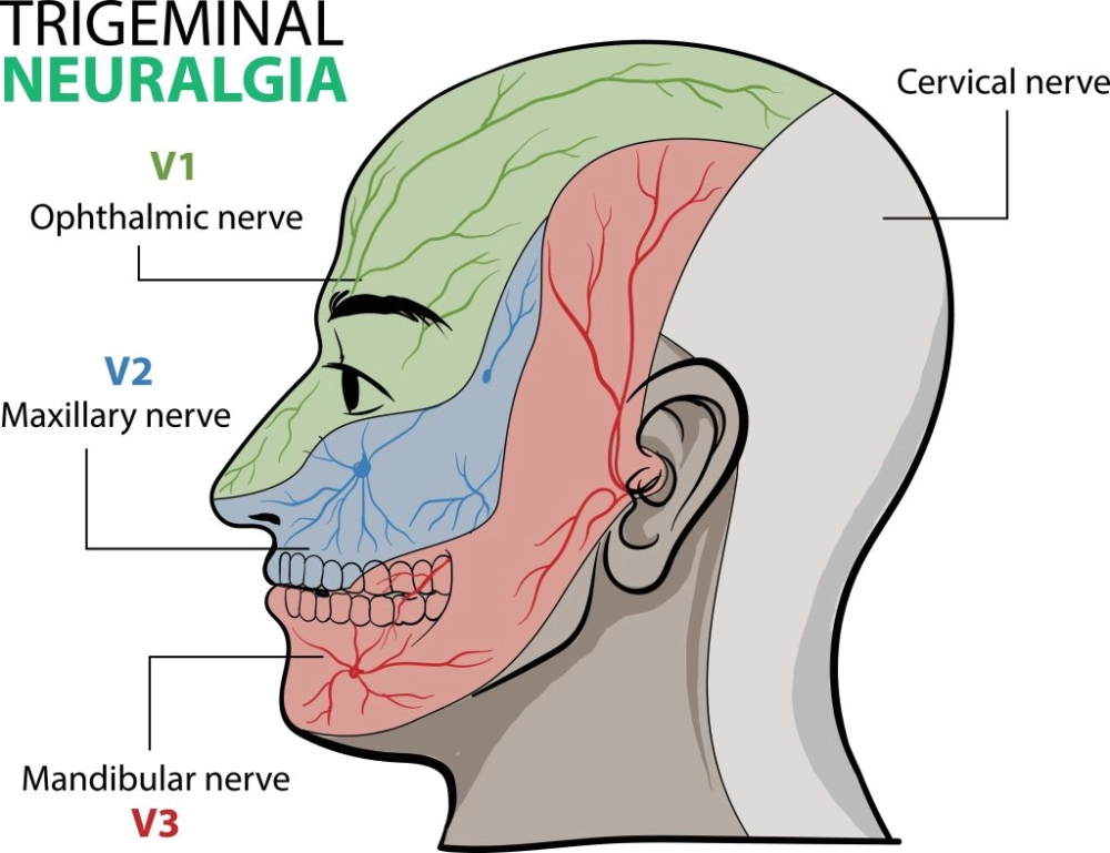 An illustration of the intense facial pain it causes