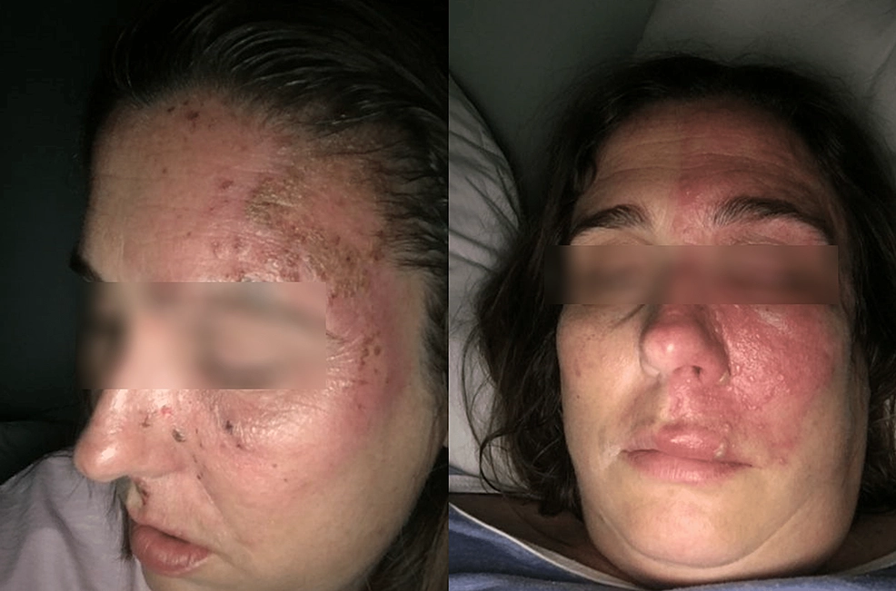 A surgical illustration of microvascular decompression