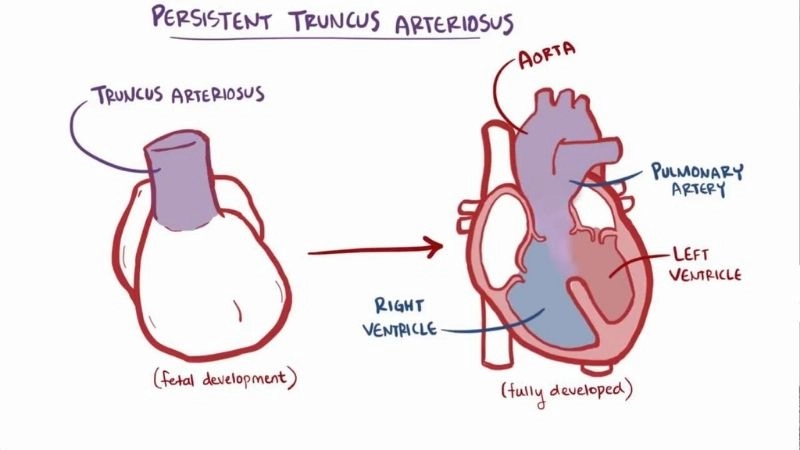 Truncus arteriosus surgery procedures and recovery guide