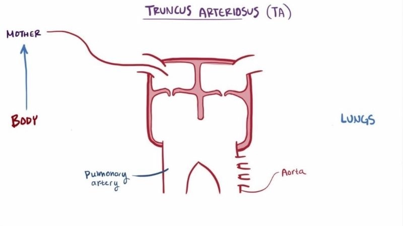 Truncus arteriosus repair surgical options and outcomes