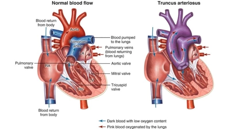 Truncus arteriosus diagnosis tests and imaging explained