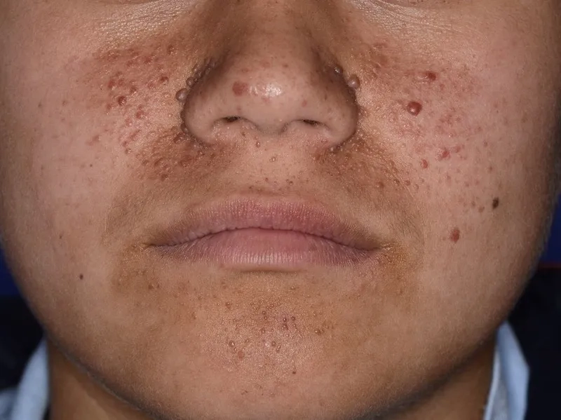 Research diagram on TSC in clinical neurology studies