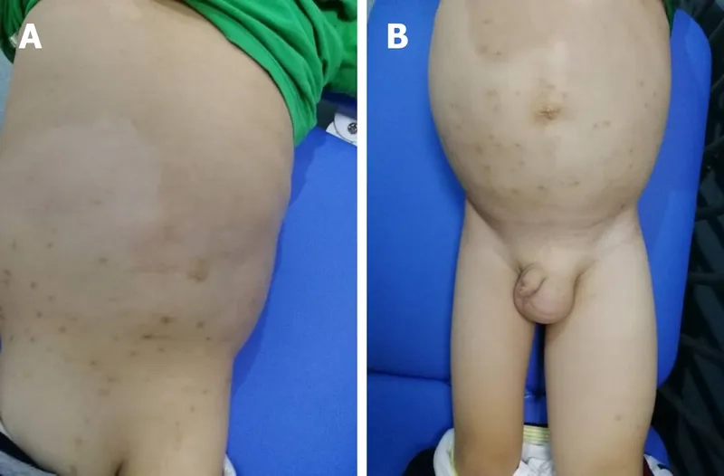 Genetic analysis chart of tuberous sclerosis genetics