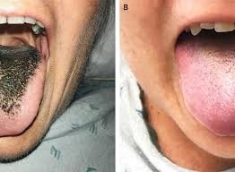 A skin ulcer from ulceroglandular tularemia